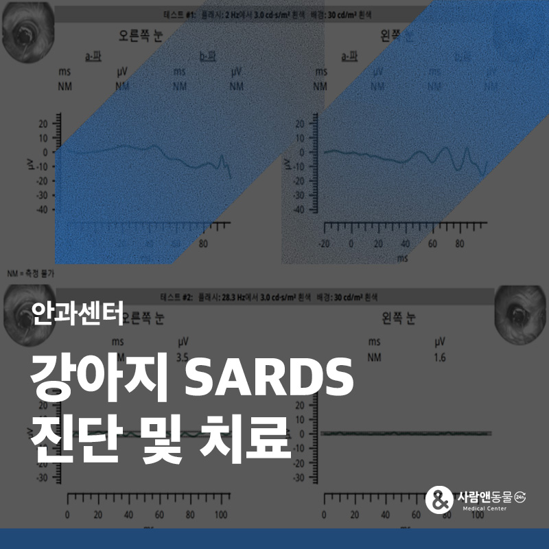 눈 상처나 충혈도 없는데 갑자기 앞이 안 보인다면? 급성 후천성 망막 변성 증후군(SARDS) 진단 사례
